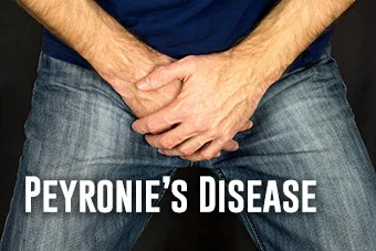 Peyronie’s disease